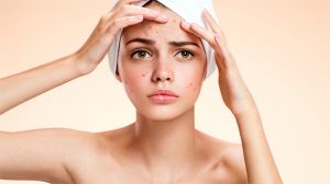 Ozone Therapy and Acne