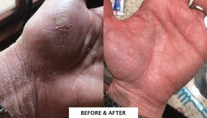 [Testimonial] Improvement from Chronic Eczema